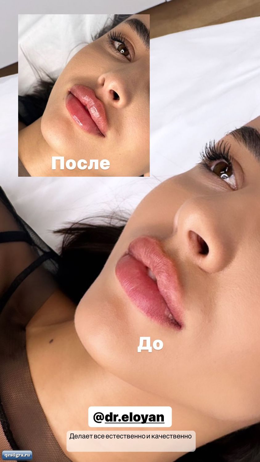 Пластический хирург объяснила, зачем девушки делают огромные губы - вторсырье-м.рф | Новости