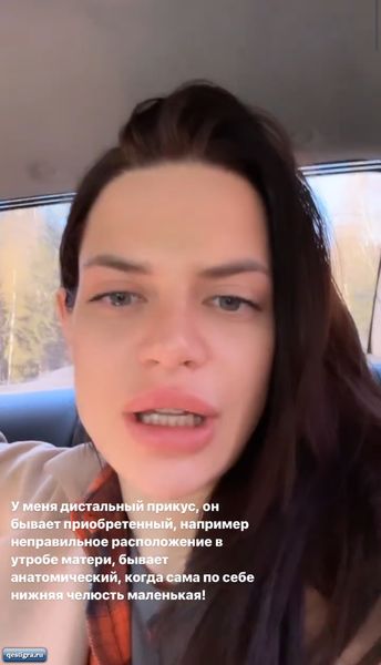 Из за неправильного расположения в утробе матери у Селены Майер неправ